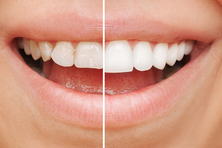 anterior view of a smile with and without veneers